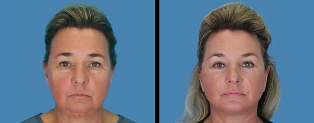 Facelift result at Avante Plastic Surgery in Houston, TX
