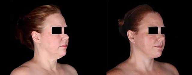 Deep Plane Facelift result at Avante Plastic Surgery in Sugar Land, TX