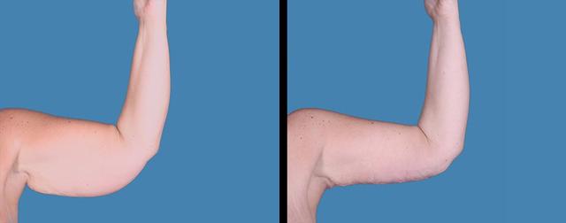Arm Lift result at Avante Plastic Surgery in Sugar Land, TX