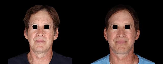 Deep Plane Facelift result at Avante Plastic Surgery in Sugar Land, TX