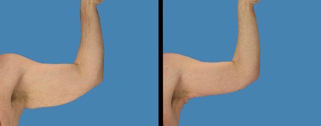 Arm Lift result at Avante Plastic Surgery in Sugar Land, TX
