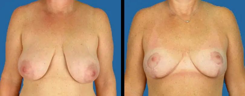 Avante Plastic Surgery breast lift result — Houston, TX