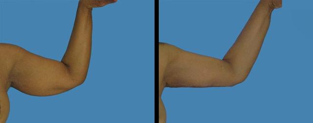 Arm Lift result at Avante Plastic Surgery in Houston, TX
