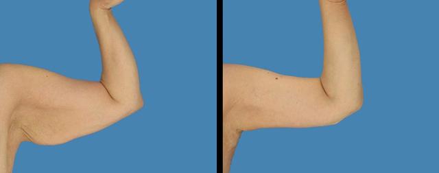 Arm Lift result at Avante Plastic Surgery in Sugar Land, TX