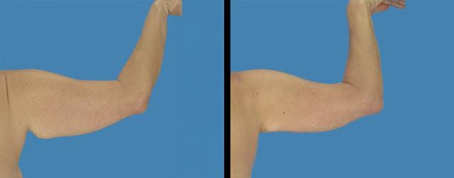 Arm Lift result at Avante Plastic Surgery in Sugar Land, TX