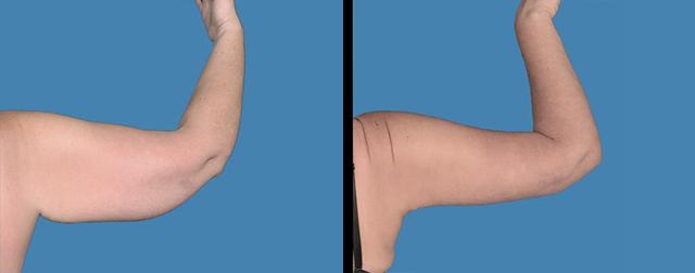 Arm Lift result at Avante Plastic Surgery in Sugar Land, TX