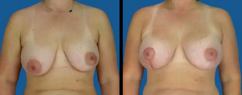 Avante Plastic Surgery breast lift result — Houston, TX