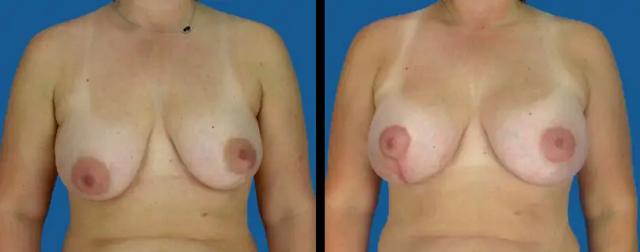 Breast Lift result at Avante Plastic Surgery in Sugar Land, TX