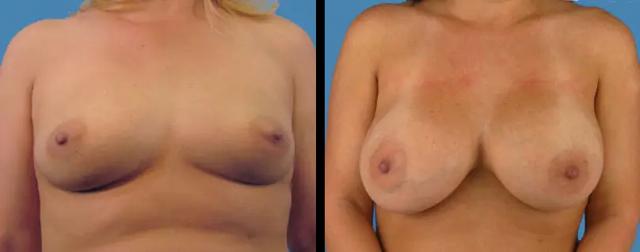 Breast Augmentation result at Avante Plastic Surgery in Sugar Land, TX