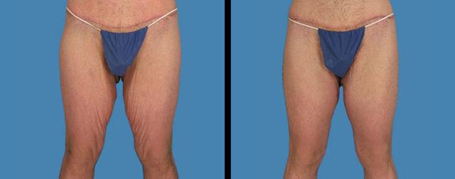 Thigh Lift result at Avante Plastic Surgery in Houston, TX