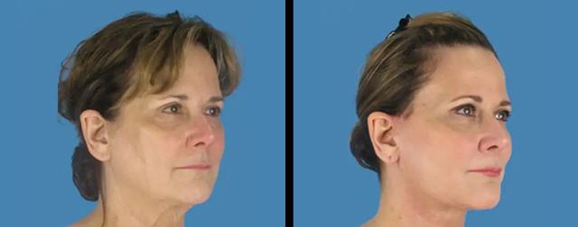 Deep Plane Facelift result at Avante Plastic Surgery in Sugar Land, TX