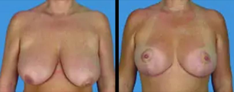 Avante Plastic Surgery breast lift result — Houston, TX