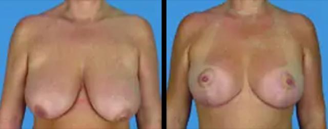 Breast Lift result at Avante Plastic Surgery in Houston, TX