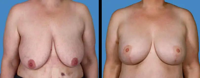 Avante Plastic Surgery breast lift result — Houston, TX