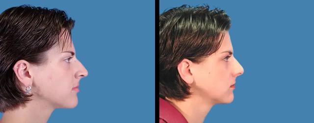 Rhinoplasty result at Avante Plastic Surgery in Sugar Land, TX