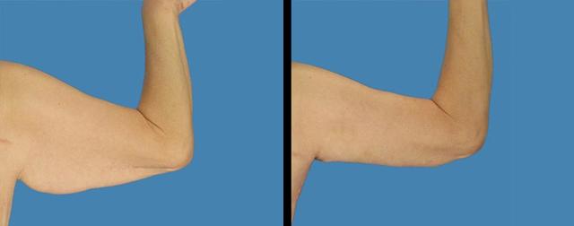 Arm Lift result at Avante Plastic Surgery in Sugar Land, TX