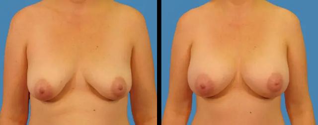 Breast Augmentation result at Avante Plastic Surgery in Houston, TX