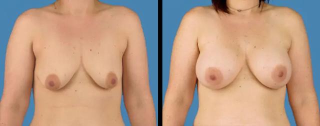 Breast Augmentation result at Avante Plastic Surgery in Sugar Land, TX