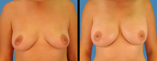 Breast Augmentation result at Avante Plastic Surgery in Sugar Land, TX