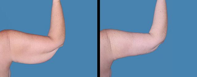 Arm Lift result at Avante Plastic Surgery in Sugar Land, TX