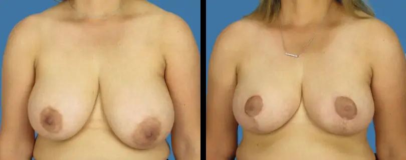 Avante Plastic Surgery breast lift result — Houston, TX