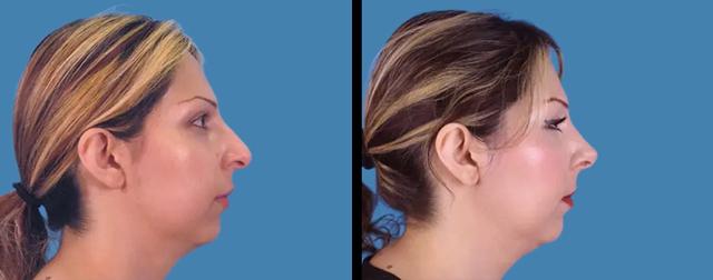 Rhinoplasty result at Avante Plastic Surgery in Sugar Land, TX
