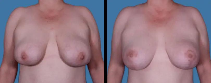 Avante Plastic Surgery breast lift result — Houston, TX