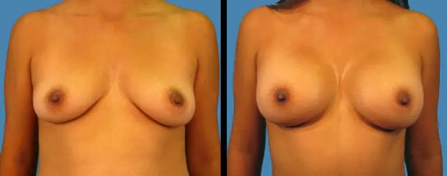 Breast Augmentation result at Avante Plastic Surgery in Sugar Land, TX