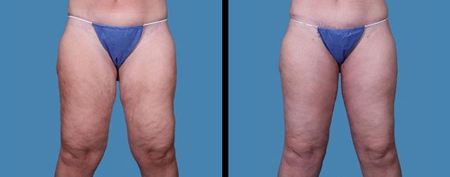Thigh Lift result at Avante Plastic Surgery in Houston, TX