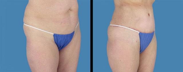 Mini Tummy Tuck result at Avante Plastic Surgery in Houston, TX
