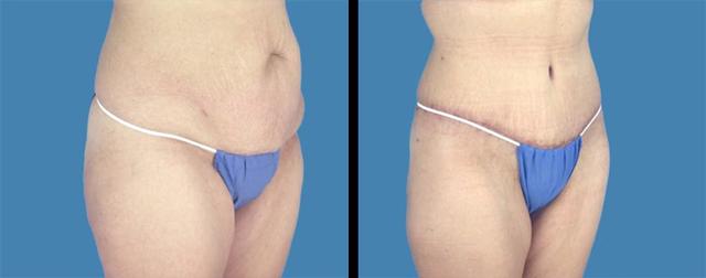 Mini Tummy Tuck result at Avante Plastic Surgery in Sugar Land, TX