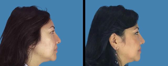Rhinoplasty result at Avante Plastic Surgery in Sugar Land, TX