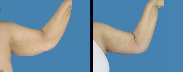 Arm Lift result at Avante Plastic Surgery in Houston, TX