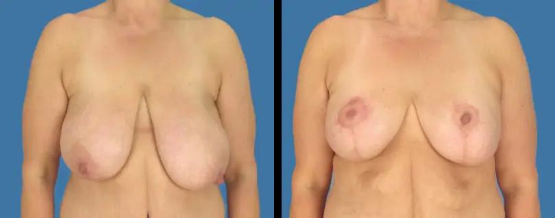 Avante Plastic Surgery breast lift result — Houston, TX