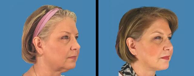 Deep Plane Facelift result at Avante Plastic Surgery in Sugar Land, TX