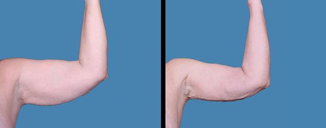 Arm Lift result at Avante Plastic Surgery in Sugar Land, TX