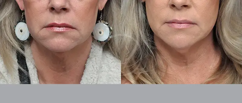 Garcia Facial Plastic Surgery facelift result — Jacksonville, FL