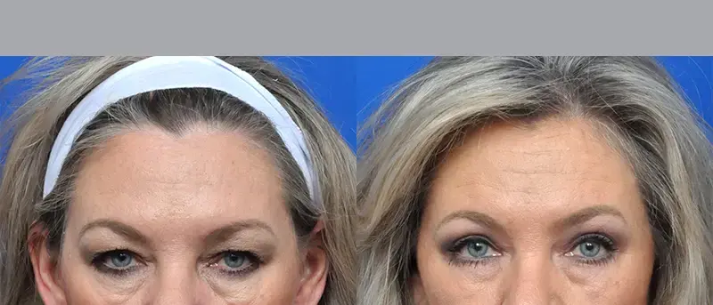 Garcia Facial Plastic Surgery eyelid lift result — Jacksonville, FL