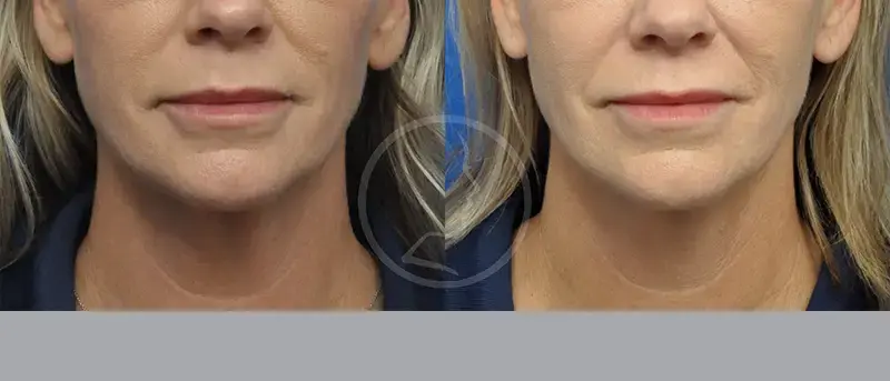 Garcia Facial Plastic Surgery facelift result — Jacksonville, FL