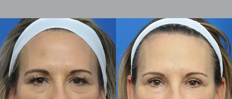 Garcia Facial Plastic Surgery eyelid lift result — Jacksonville, FL