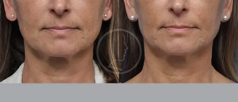 Garcia Facial Plastic Surgery facelift result — Jacksonville, FL