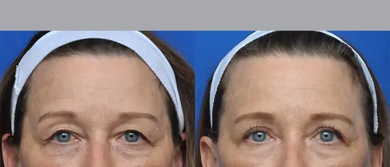 Garcia Facial Plastic Surgery eyelid lift result — Jacksonville, FL