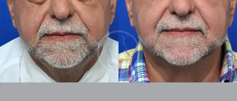 Garcia Facial Plastic Surgery facelift result — Jacksonville, FL
