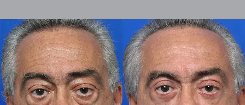 Garcia Facial Plastic Surgery eyelid lift result — Jacksonville, FL