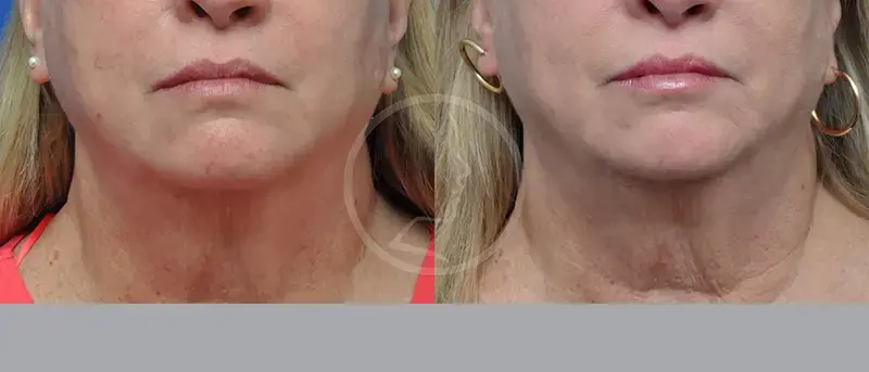 Garcia Facial Plastic Surgery facelift result — Jacksonville, FL