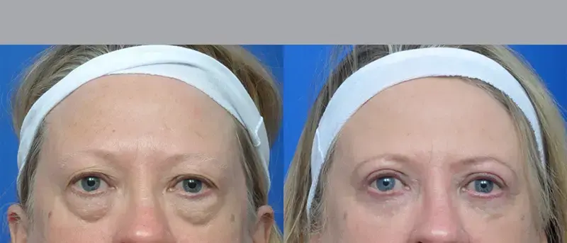 Garcia Facial Plastic Surgery eyelid lift result — Jacksonville, FL