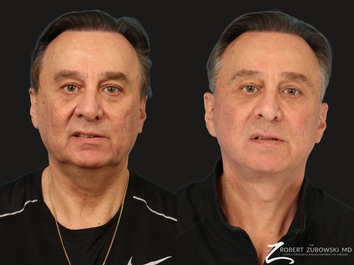 The Robert Zubowski Center facelift result — Paramus, NJ