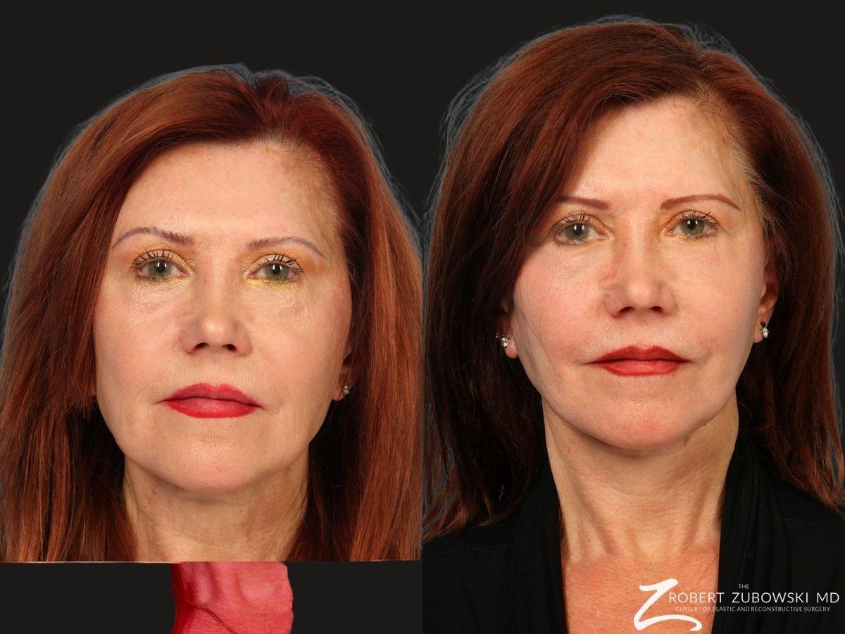 The Robert Zubowski Center facelift result — Paramus, NJ