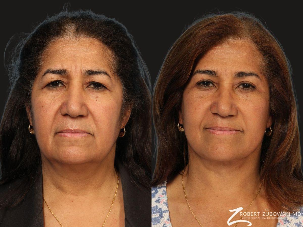 The Robert Zubowski Center facelift result — Paramus, NJ