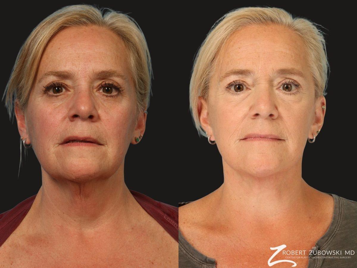 The Robert Zubowski Center facelift result — Paramus, NJ